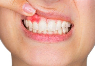 Gengivite: un'infiammazione molto seria, scopri le cause e i rimedi
